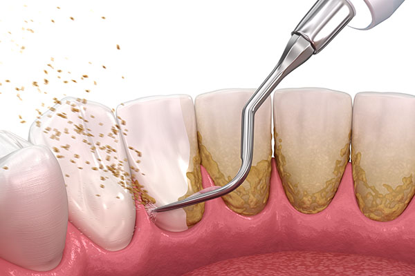 Oral hygiene: Scaling and root planing (conventional periodontal therapy). Medically accurate 3D illustration of human teeth treatment